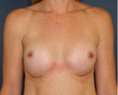 Feel Beautiful - Natural Breast Augmentation 011 - After Photo